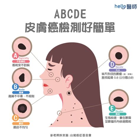 凸起來的痣|痣變大、痣多或長毛會變皮膚癌？認識痣的形成與原因